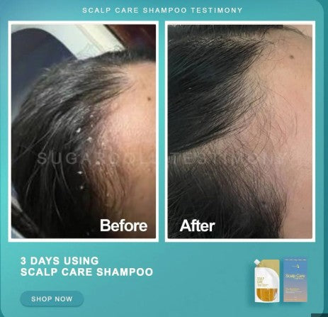 SUGARDOLL HAIR CARE | ANTI-DANDRUFF